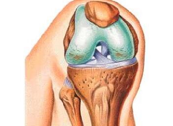 Les principales causes de l'arthrose du genou