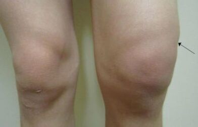 Manifestations cliniques de l'arthrose de l'articulation du genou