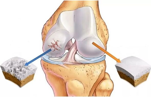 Cartilage et cartilage sain affectés par l'arthrose