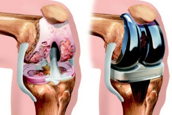 avant et après l'endoprosthétique de l'articulation du genou avec arthrose
