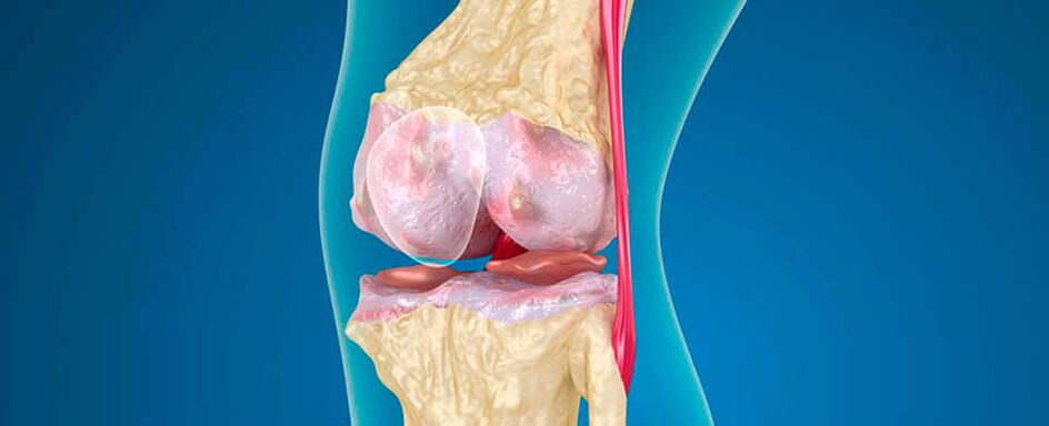 arthrose de l'articulation du genou