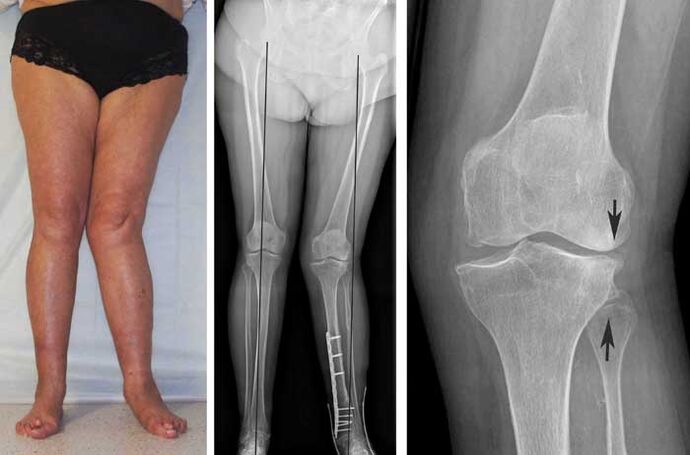 arthrose avancée de l'articulation du genou