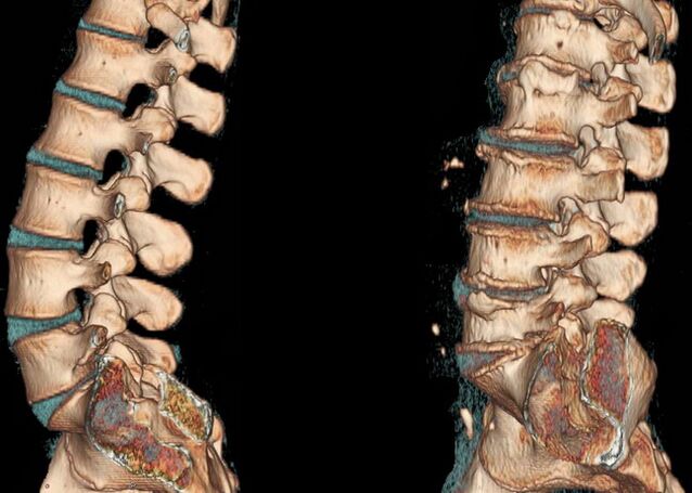 Ostéochondrose de la colonne vertébrale sur un scanner