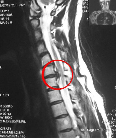 Symptômes de l'ostéochondrose thoracique sur une radiographie